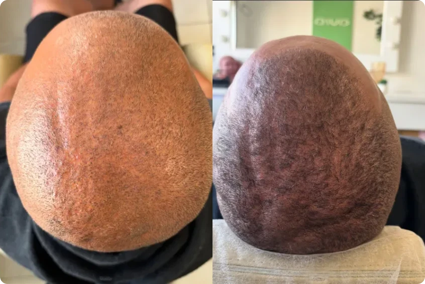 Recuperação da densidade capilar