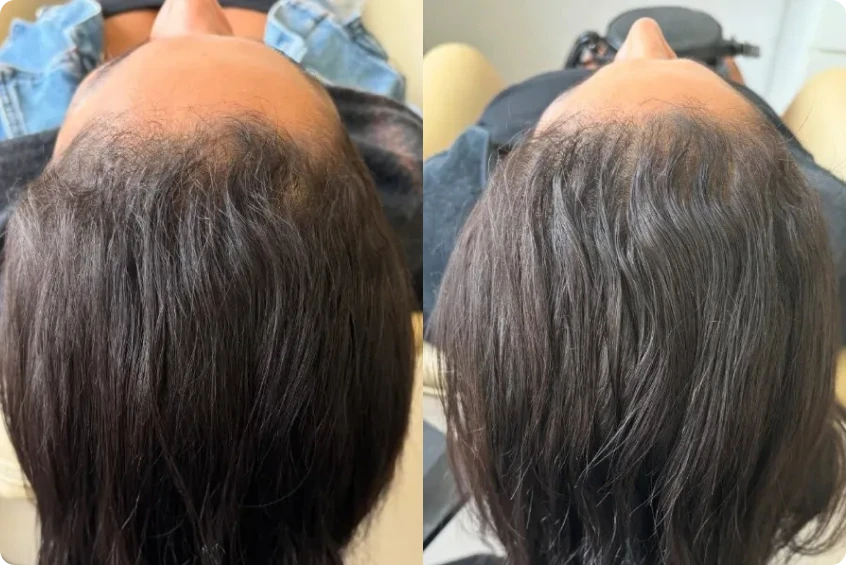 Resultado clínico após protocolo capilar